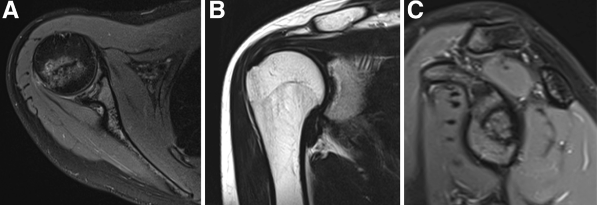 Osteochondritis Dissecans of the Glenoid
