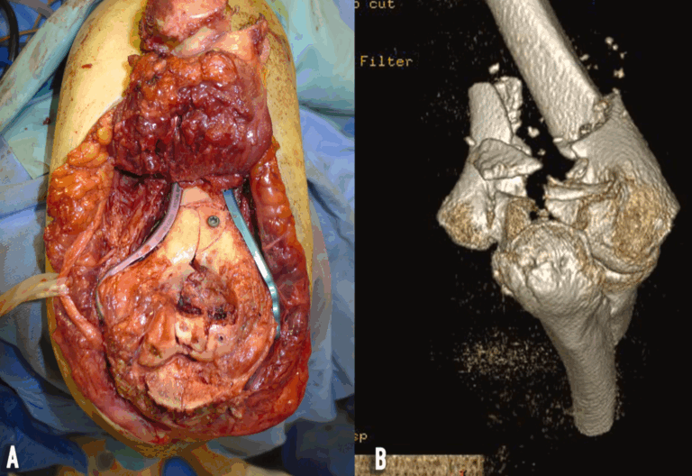 distal humerus joint fractures