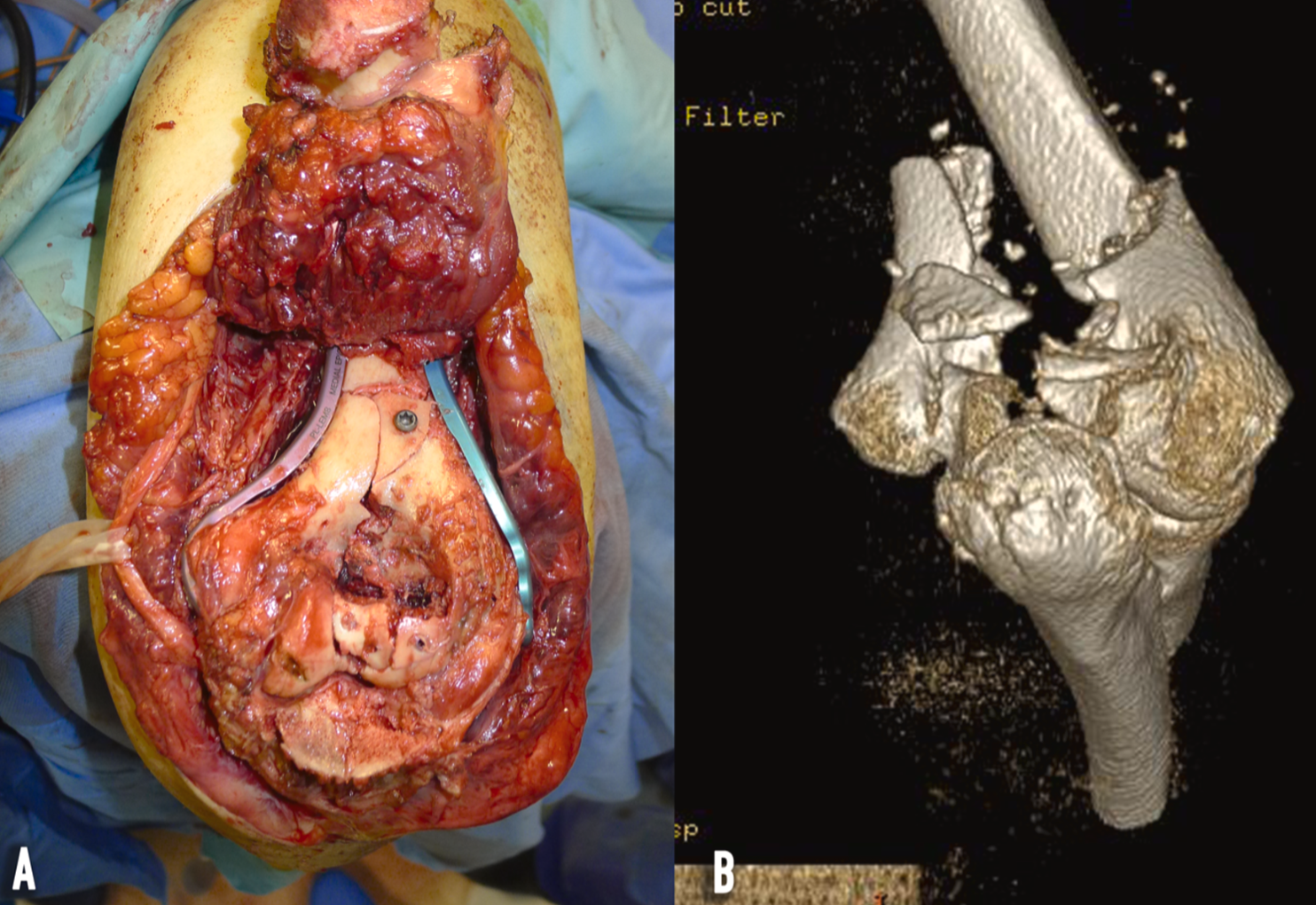 distal humerus joint fractures