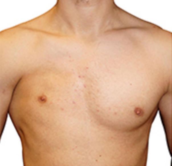 Shoulder motion with inertial sensors in Poland syndrome patients