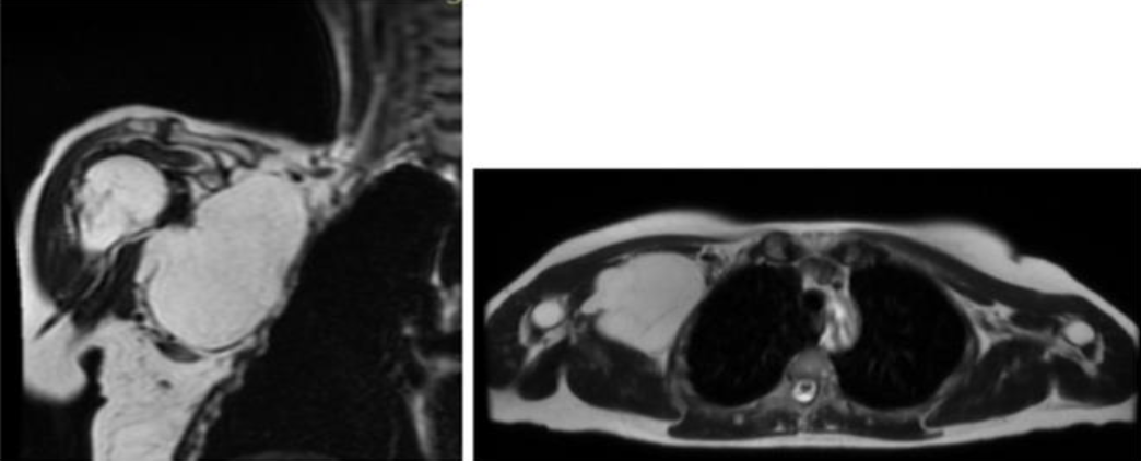 Atypical Deep-Seated Lipomatous Tumors Shoulder