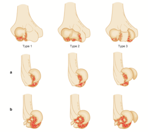 Coronal shear fractures of the elbow