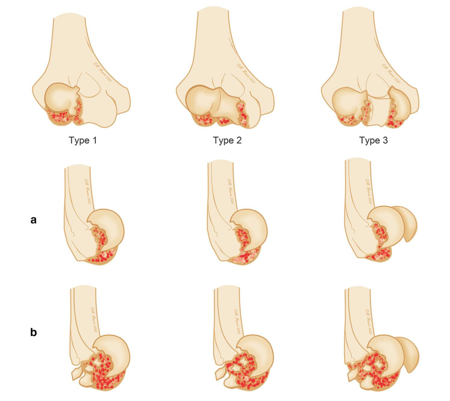Coronal shear fractures of the elbow