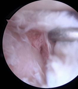 Neurogenic quadrilateral space syndrome