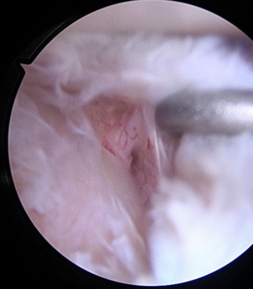 Neurogenic quadrilateral space syndrome