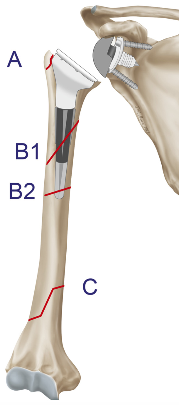 Periprosthetic Humeral Fracture