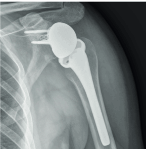 The use of computer navigation in reverse shoulder arthroplasty revision