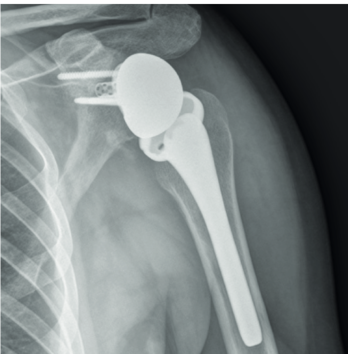 The use of computer navigation in reverse shoulder arthroplasty revision